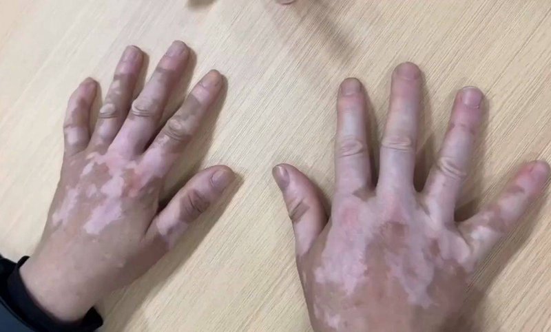 宿迁白癜风