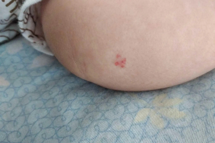 婴儿血管瘤